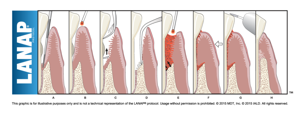 Illustration depicting the LANAP protocol steps for treating gum disease, showing sequential stages involving laser treatment around a tooth.