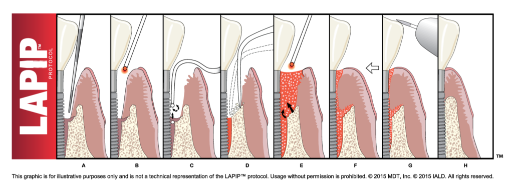Illustration depicting the LAPIP protocol steps for treating peri-implantitis, showing sequential stages involving laser treatment around a dental implant.